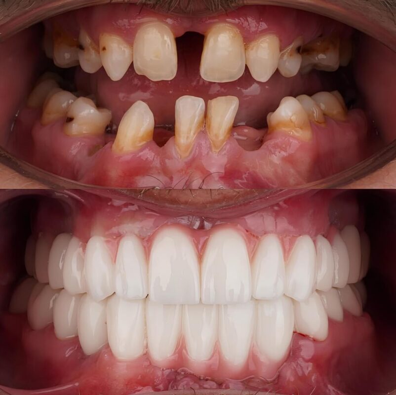 dental implants bone loss